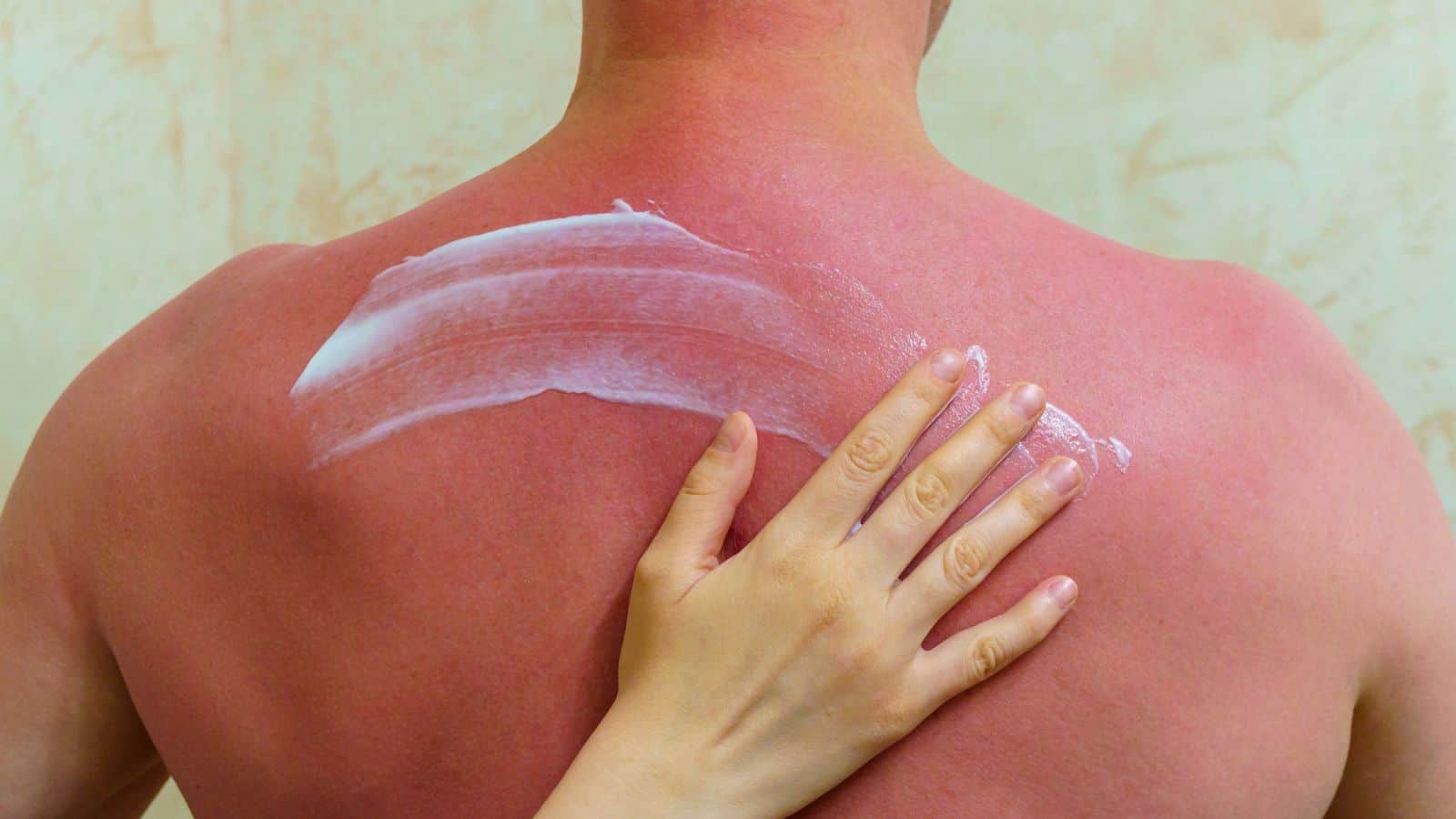 do not use vaseline on sunburn